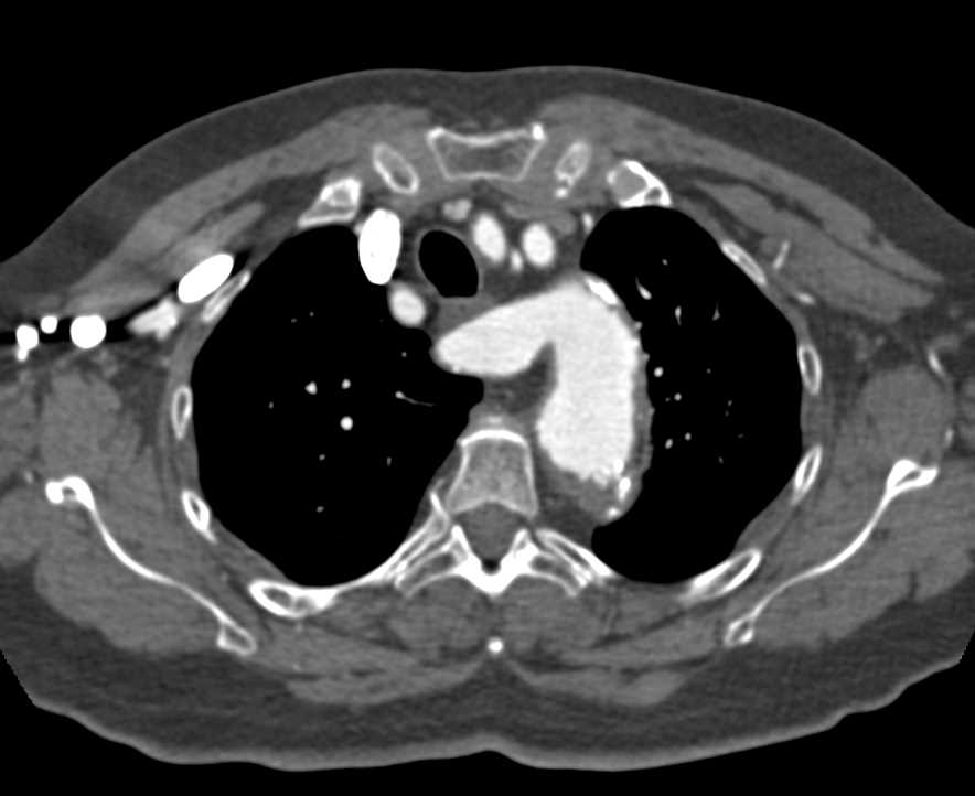 Aberant Right Subclavian Artery off the Aorta - CTisus CT Scan