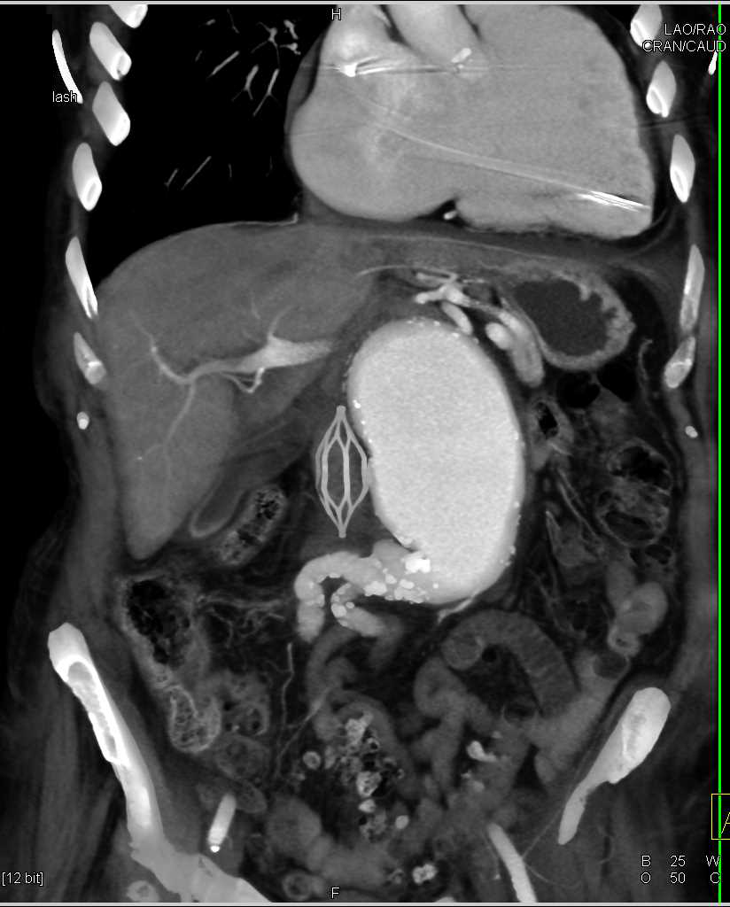 Abdominal Aortic Aneurysm - CTisus CT Scan