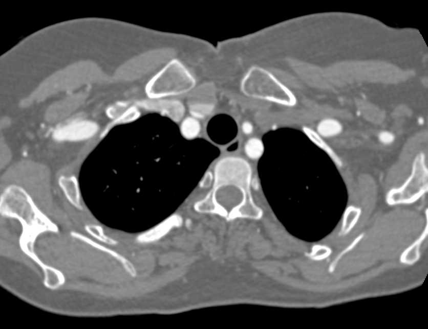 Type A Dissection with Extension into the Left Carotid and Subclavian Artery - CTisus CT Scan