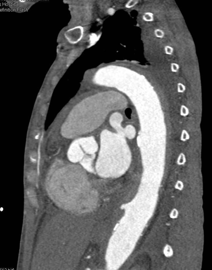 Ulcerations Descending Thoracic Aorta with Intramural Hematoma - CTisus CT Scan