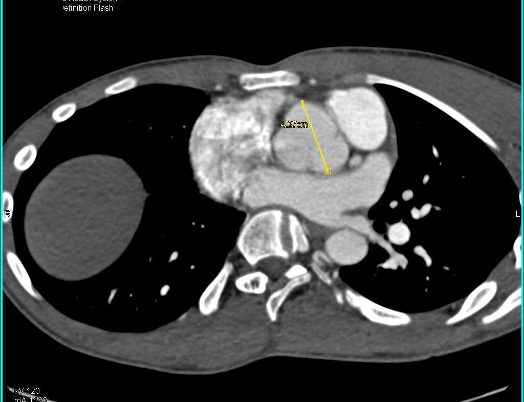 Dilated Aortic Root in Marfan Syndrome - CTisus CT Scan