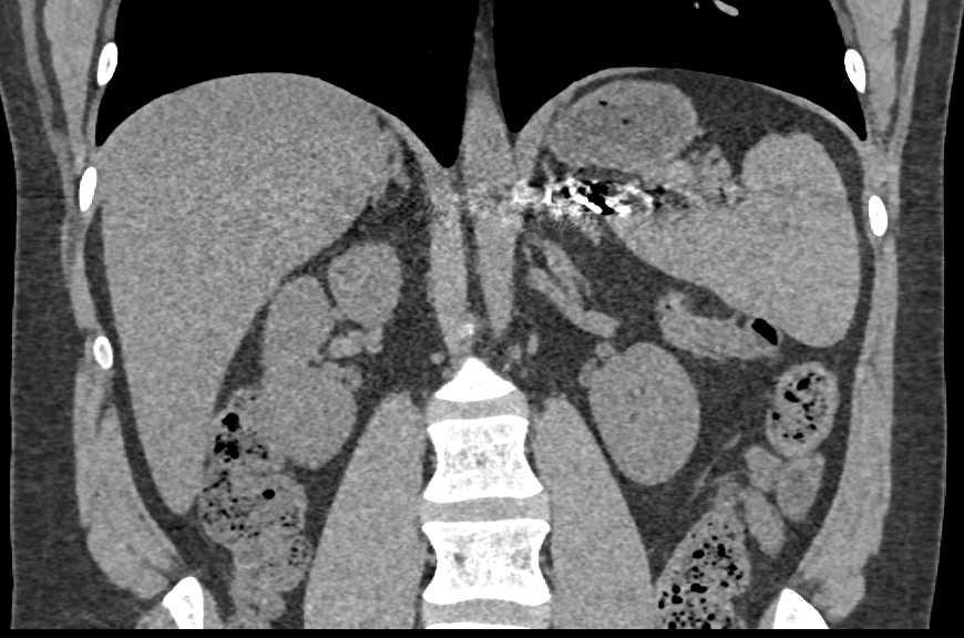 Aneurysm of the Bronchial Artery - CTisus CT Scan