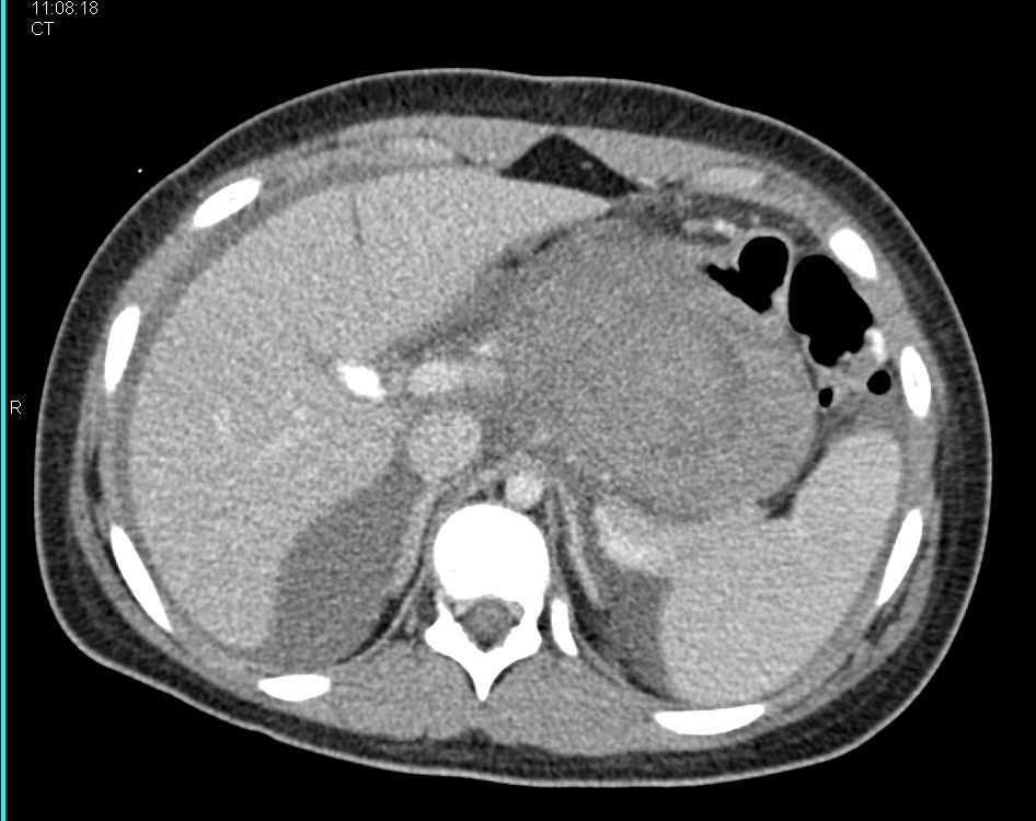 Hematoma in the Lesser Sac - CTisus CT Scan