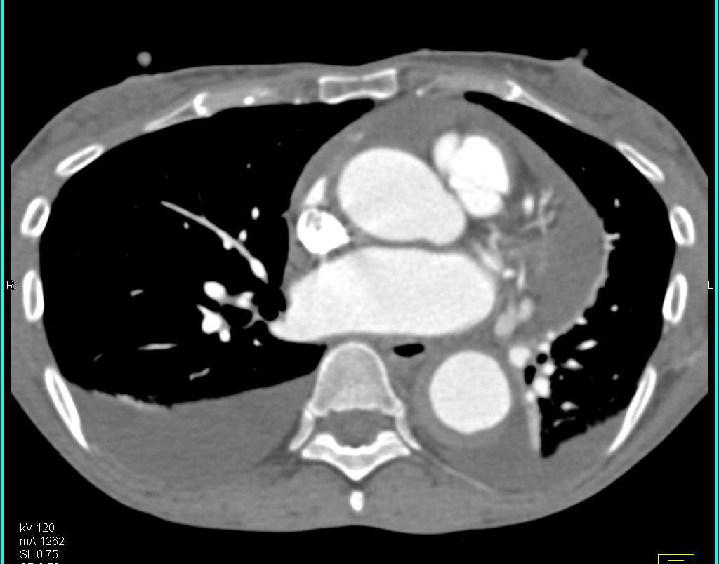 Penetrating Ulcer in the Descending Thoracic Aorta - CTisus CT Scan