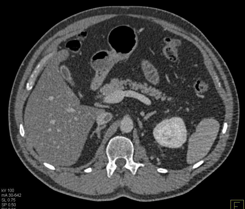 Left Renal Vein Thrombus Extends into the Inferior Vena Cava (IVC). IVC Clot also seen - CTisus CT Scan