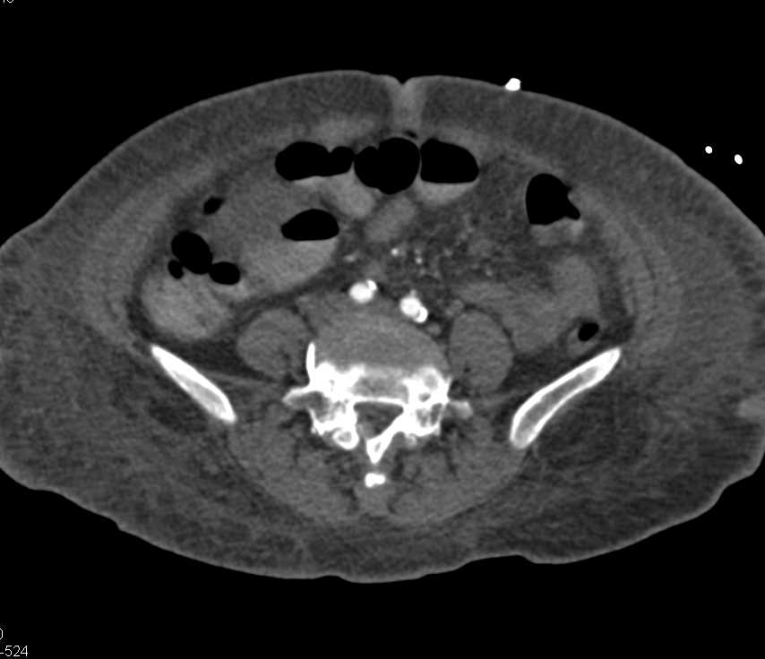 Acute Embolism Occludes the Left Femoral Artery - CTisus CT Scan