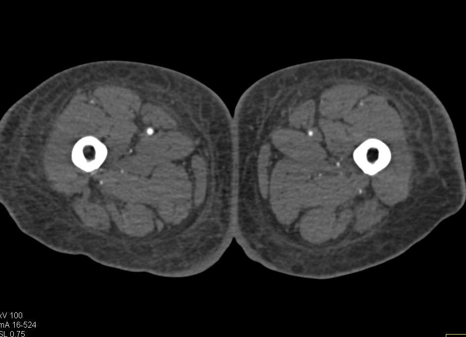 Acute Embolism Occludes the Left Femoral Artery with Bone Edits - CTisus CT Scan