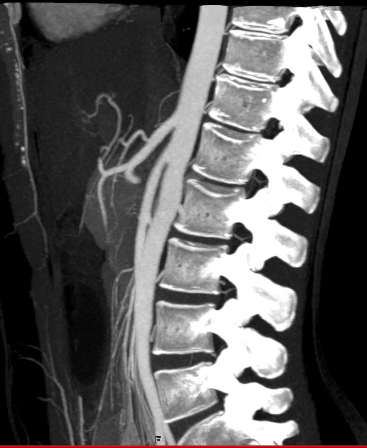 Superior Mesenteric Artery (SMA) Syndrome with Narrowed SMA Angle - CTisus CT Scan