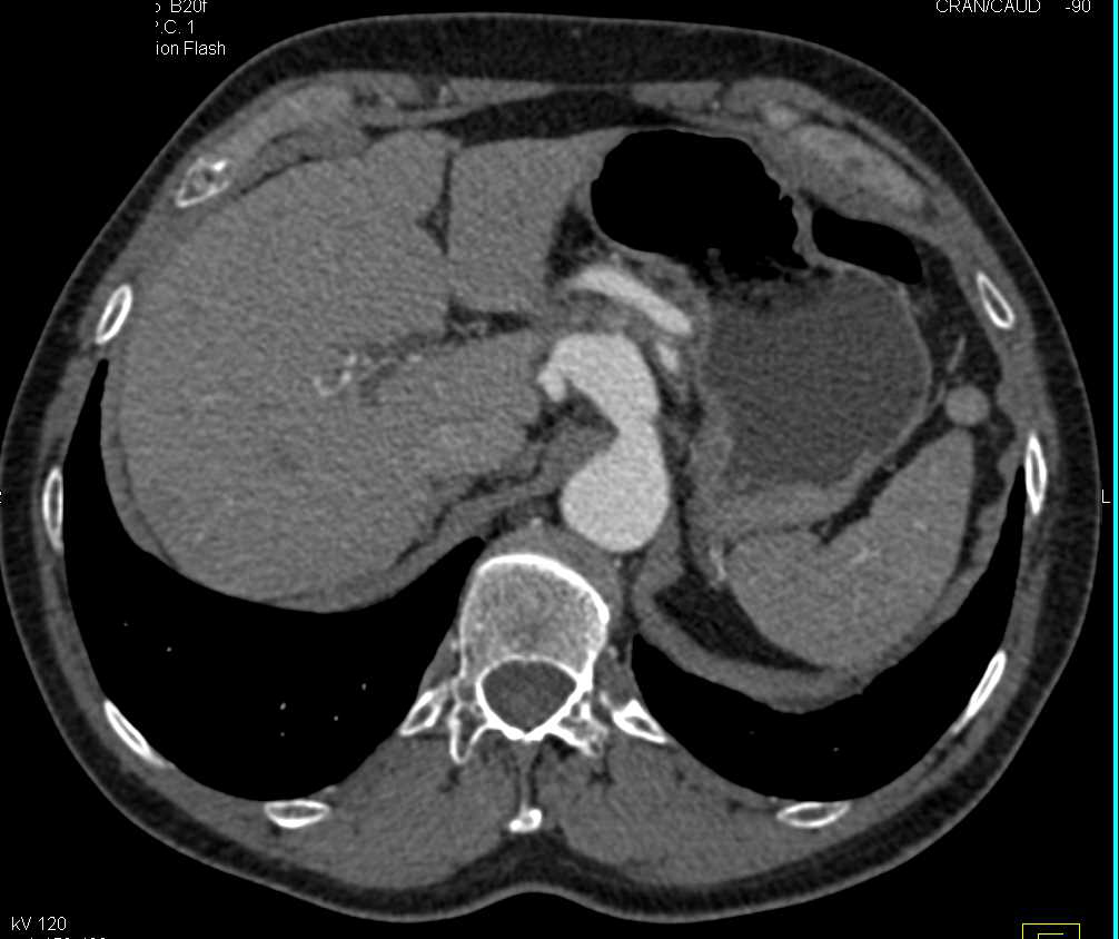 Celiac Artery Aneurysm and Endovascular Stent Repair - CTisus CT Scan