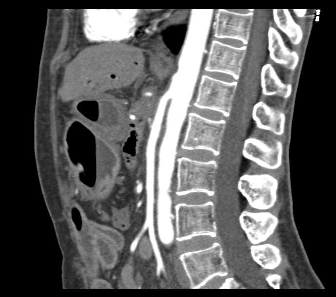 Superior Mesenteric Artery (SMA) Syndrome with Narrow SMA Angle - CTisus CT Scan