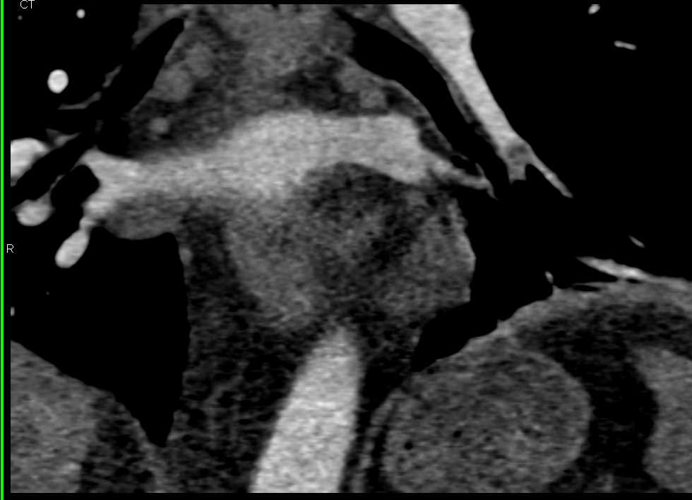 Pulmonary Embolism Right Lower Lobe Pulmonary Artery and Pseudo-Dissection Aortic Root - CTisus CT Scan