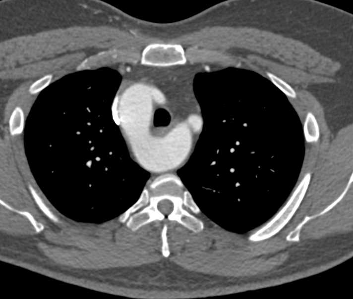 Incomplete Vascular Ring with Right Sided Arch and Visualization of Left Carotid Artery and Subclavian Artery - CTisus CT Scan
