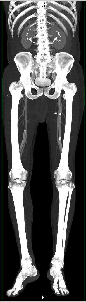 CTA with Arterial Phase Imaging and No Venous Flow in 3D in Stents - CTisus CT Scan