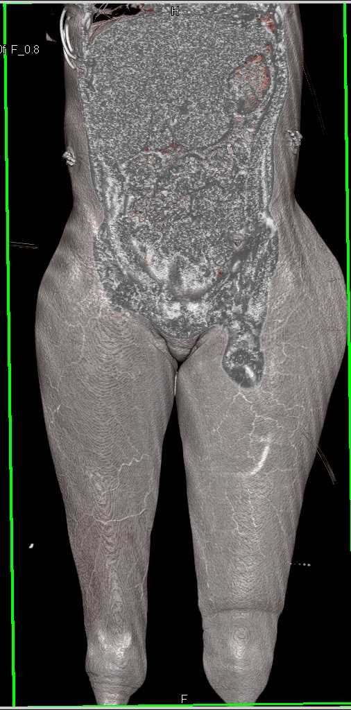 Left Arteriovenous (AV) Fistulae Created in Renal Failure Patient - CTisus CT Scan