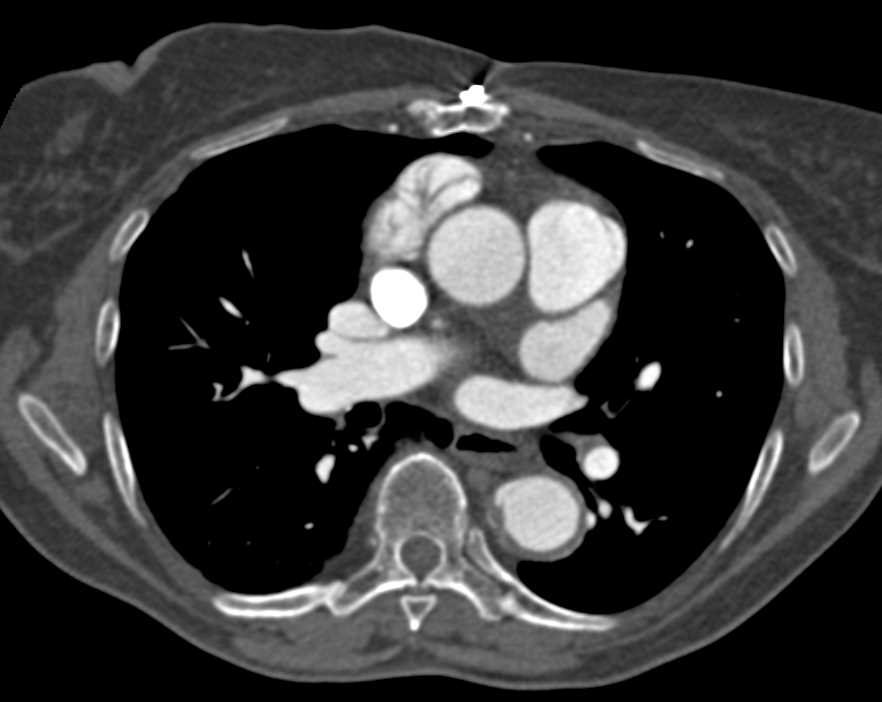 Type B Dissection with Ulcerations in the Descending Thoracic Aorta - CTisus CT Scan