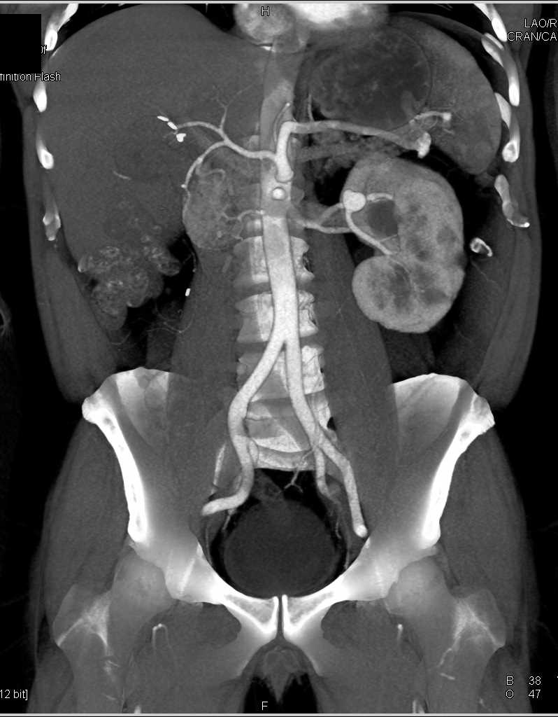 Left Renal Artery Aneurysm - CTisus CT Scan