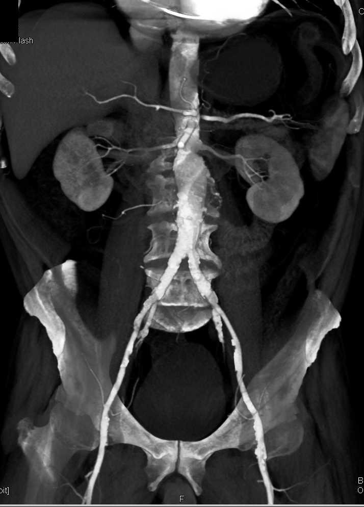 Abdominal Aortic Aneurysm with 3D VRT - CTisus CT Scan