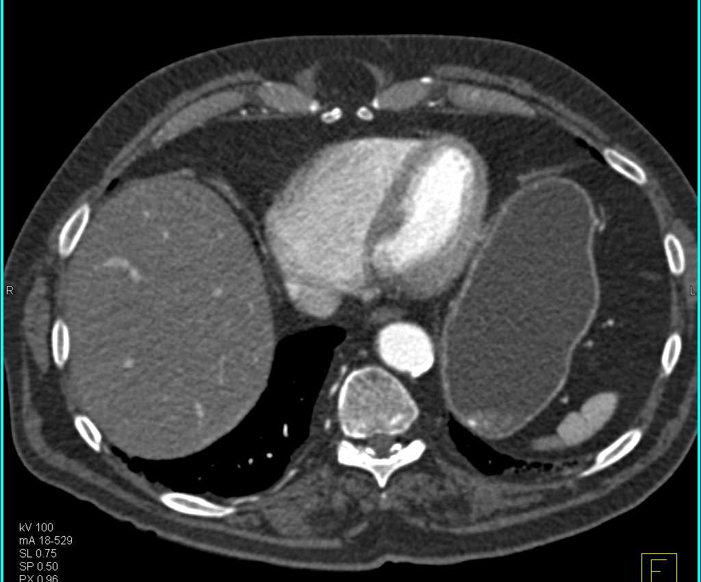 CTA with Stent in Right Common Iliac Artery - CTisus CT Scan
