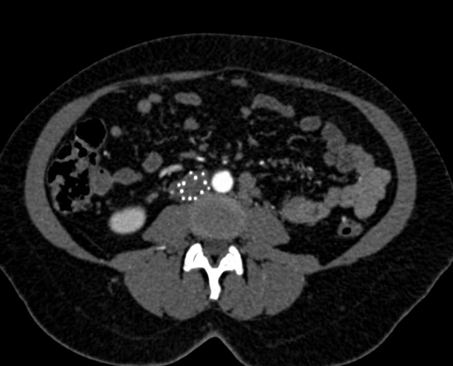 Invasive Uterine Cancer with Inferior Vena Cava (IVC) Clot and Filter - CTisus CT Scan
