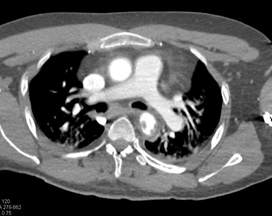 Laceration Descending Thoracic Aorta - CTisus CT Scan