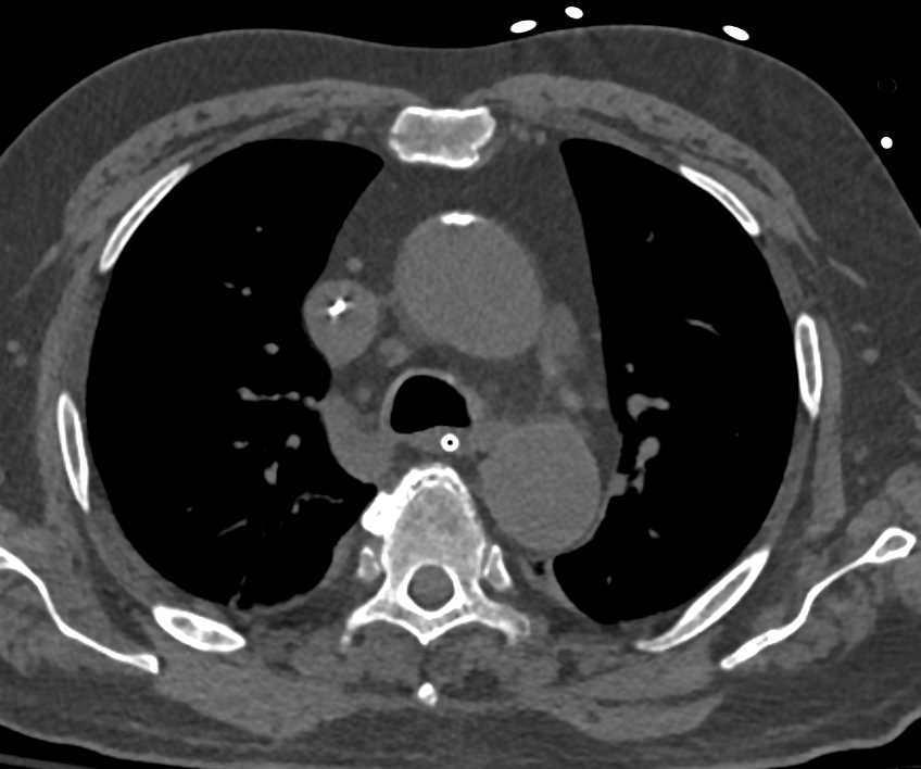 Atherosclerotic Changes Thoracic Aorta - CTisus CT Scan