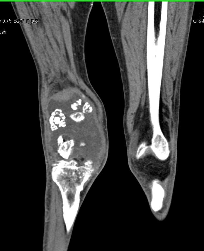 Swollen Knee Joint with Pigmented Villonodular Synovitis (PVNS) and Poor Vascular Runoff Study - CTisus CT Scan