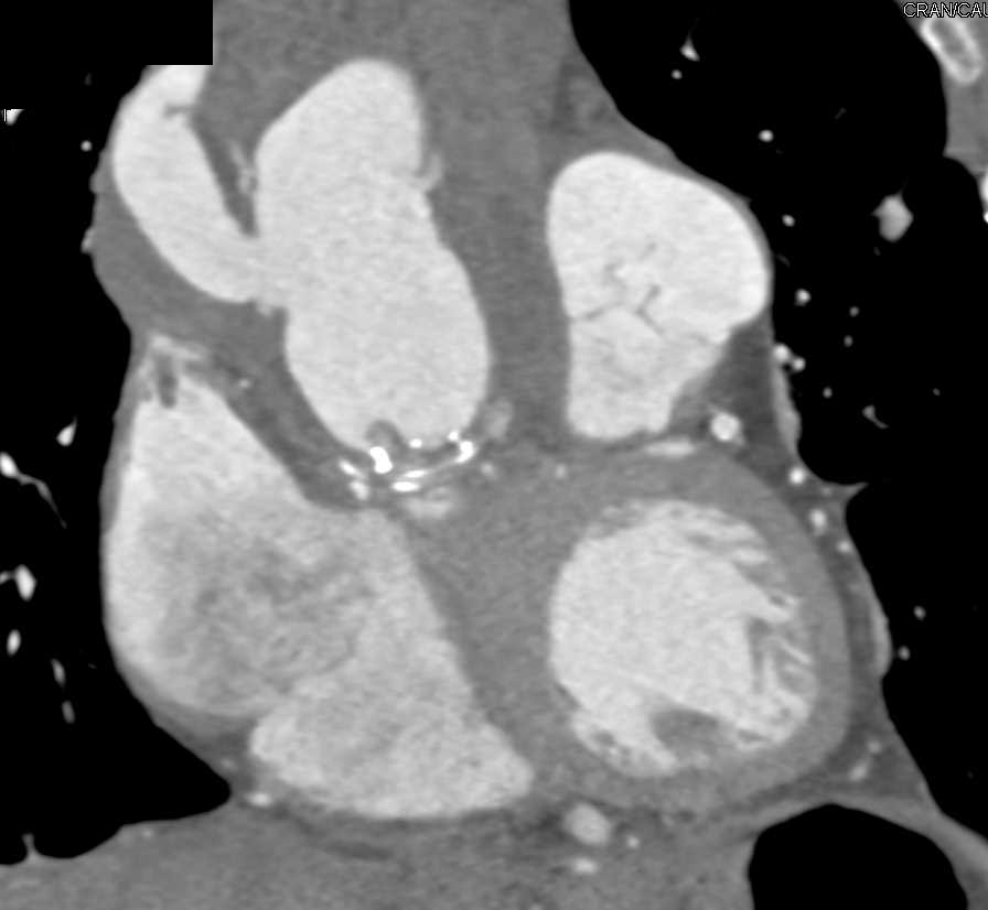 Aneurysm Repair with Multiple Collaterals in the Abdomen in an Unusual Pattern - CTisus CT Scan