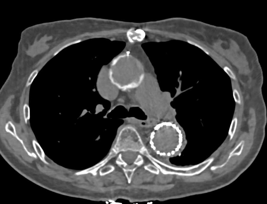 Endovascular Stent for Aneurysm Repair - CTisus CT Scan