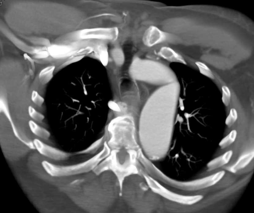 Aneurysm Descending Thoracic Aorta - CTisus CT Scan