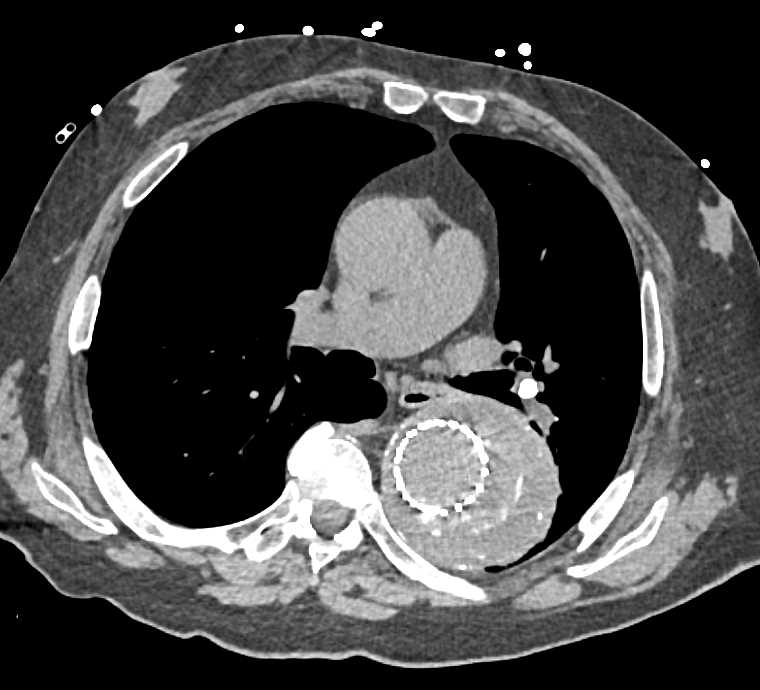 Endovascular Stent in Thoracic Aortic Aneurysm - CTisus CT Scan