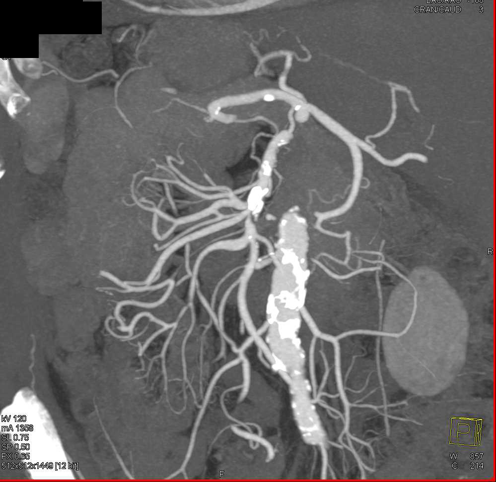 Stenosis in Superior Mesenteric Artery (SMA) Branches with Vascular Calcifications - CTisus CT Scan