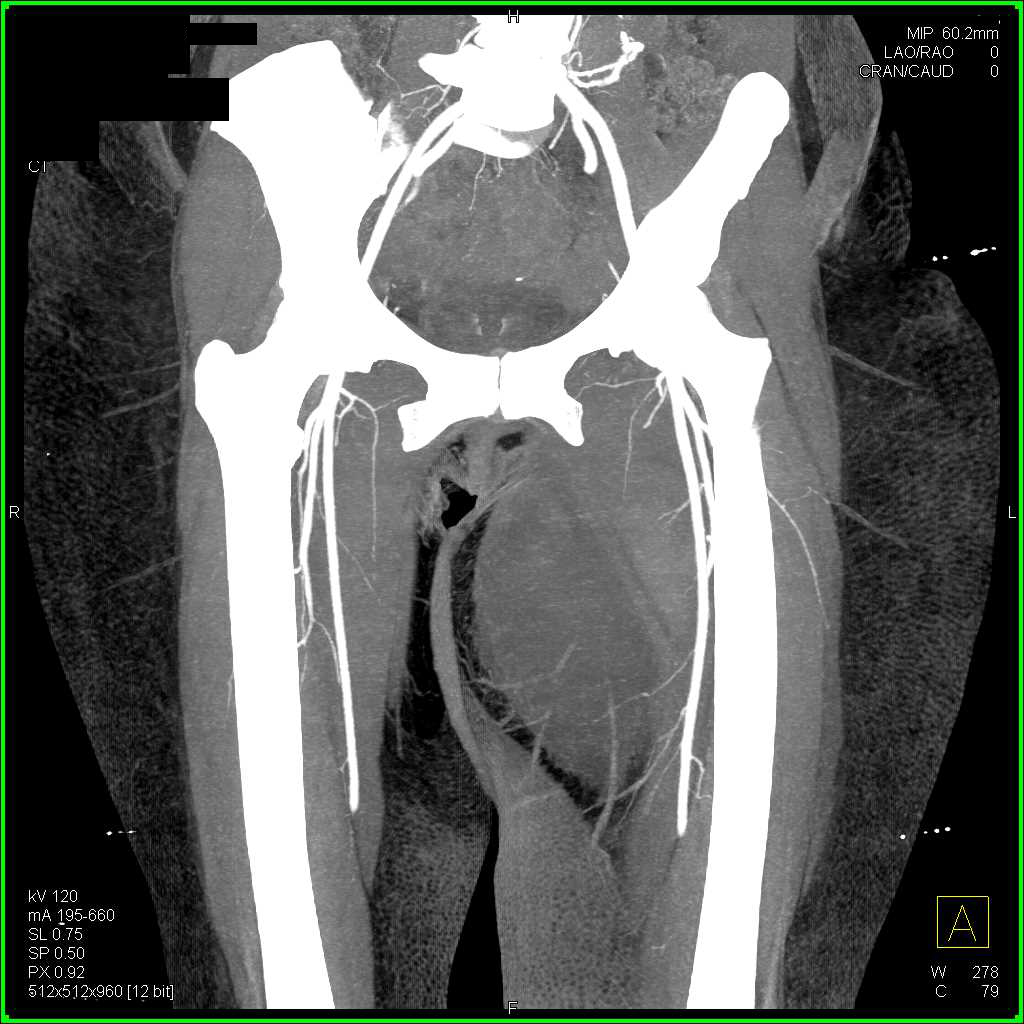 Left Thigh Hematoma Without Active Bleed - CTisus CT Scan