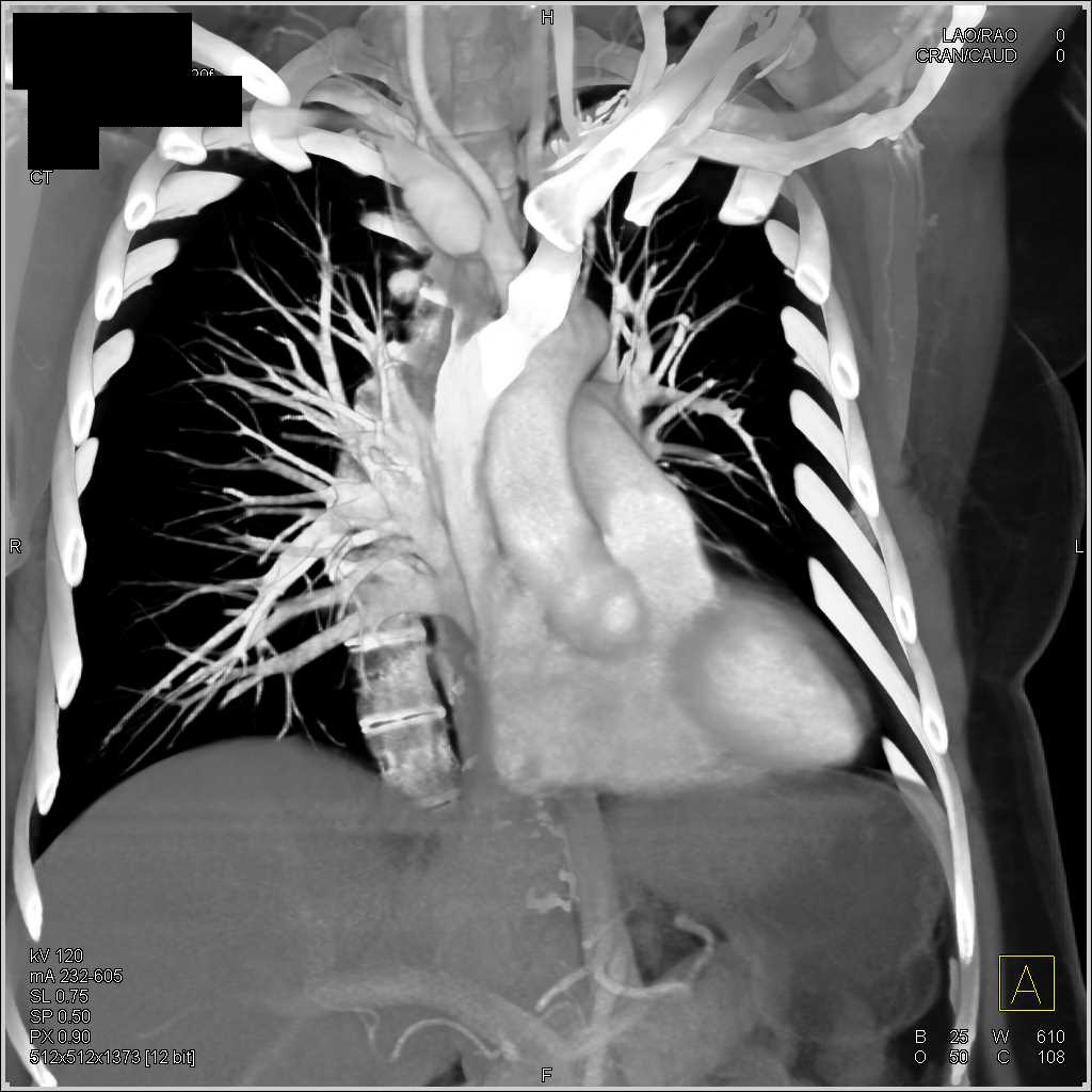 Right Subclavian Artery Aneurysm - CTisus CT Scan