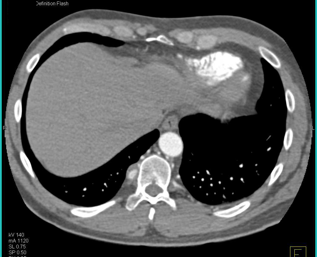 Ehlers-Danlos Syndrome with Left Subclavian Artery Aneurysm and Intercostal Artery Aneurysms - CTisus CT Scan