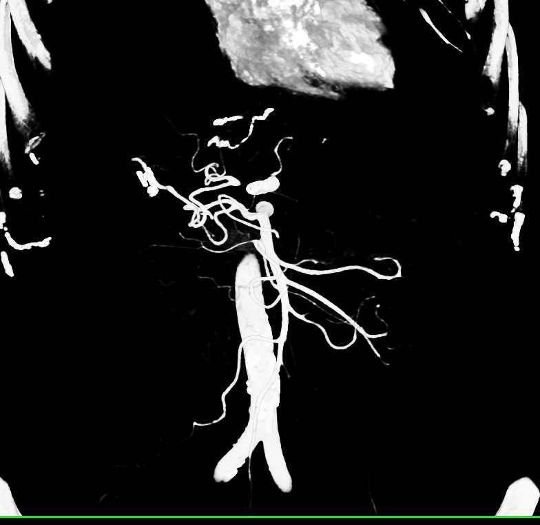 Celiac Artery Occlusion with Stent - CTisus CT Scan