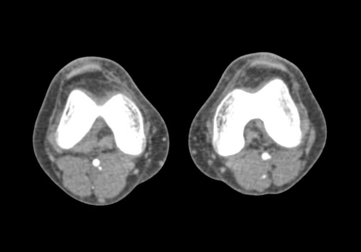 CTA Runoff with Mild Disease in Trifurcation Vessels - CTisus CT Scan