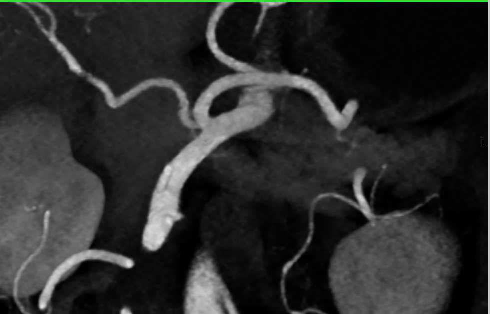 Celiac and Superior Mesenteric Artery (SMA) Arise from a Common Trunk - CTisus CT Scan