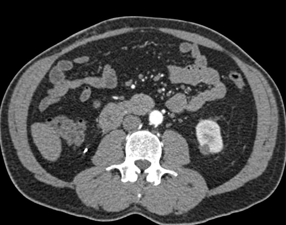 Endovascular Stent and Grafts to Superior Mesenteric Artery (SMA) and Celiac Arteries - CTisus CT Scan