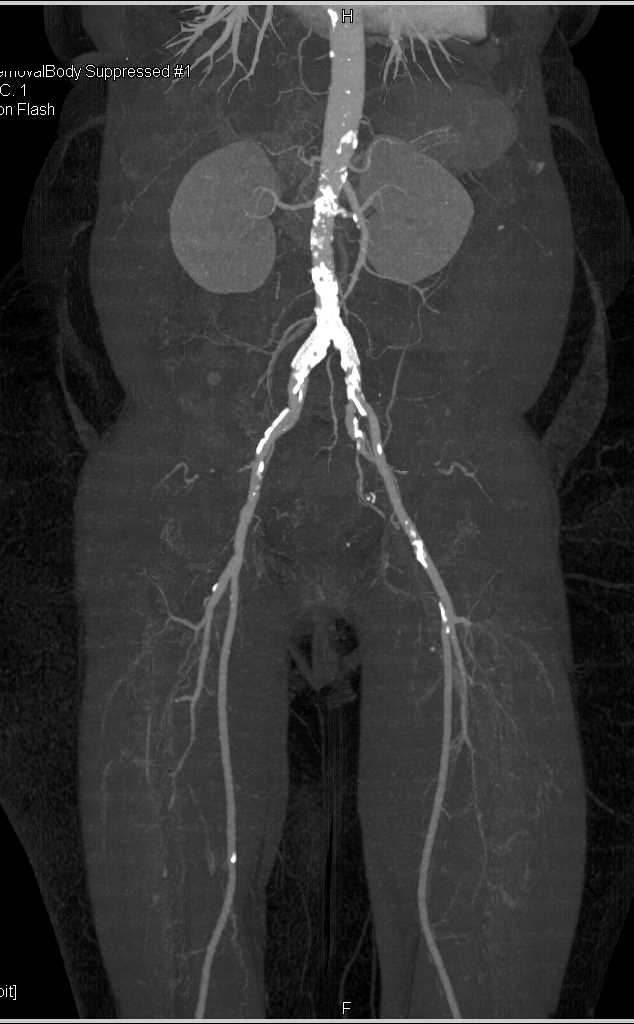 Dual Energy CTA with Extensive Aortic Vascular Calcifications - CTisus CT Scan