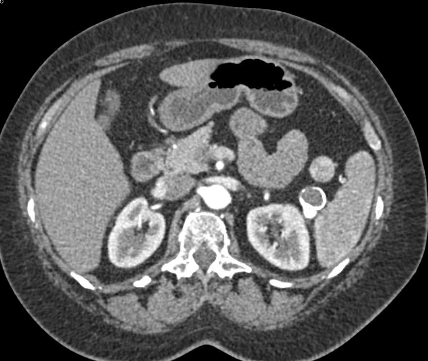 Splenic Artery Aneurysm - CTisus CT Scan