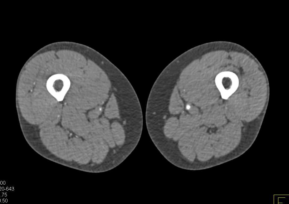 Occlusion of Right Superficial Femoral Artery (SFA) on CTA Runoff - CTisus CT Scan