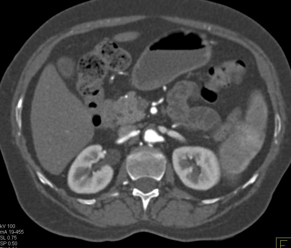 CTA with Occlusion of the Iliac Arteries Bilaterally - CTisus CT Scan