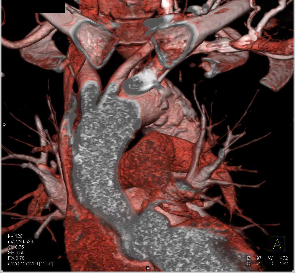 Stenosis Left Subclavian Artery - CTisus CT Scan