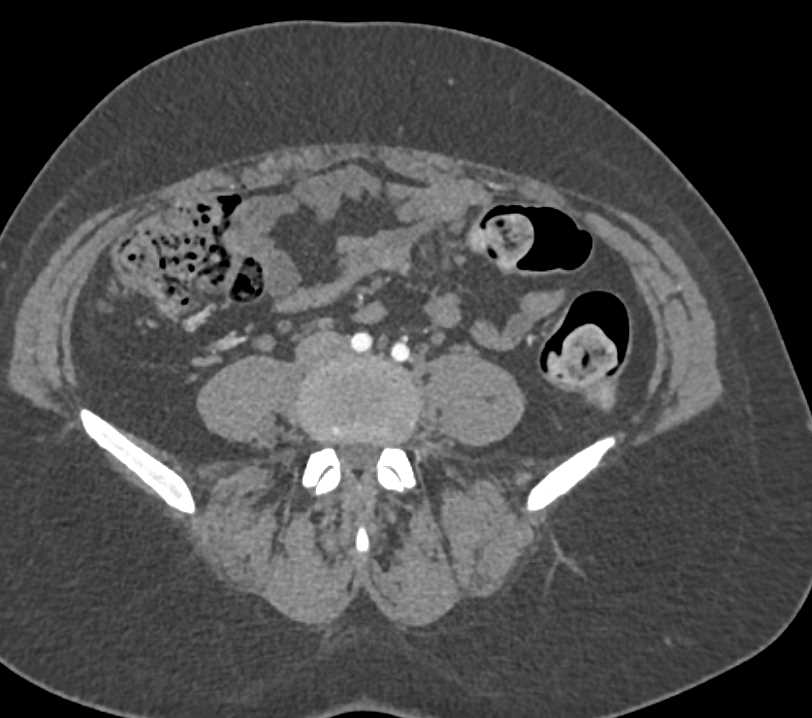 Left Femoral Vein Thrombosis - CTisus CT Scan