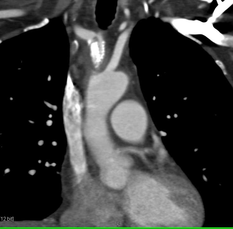 Stent in Right Innominate Artery - CTisus CT Scan