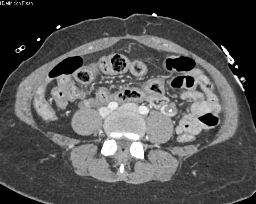 Clot in Left Gonadal Vein - CTisus CT Scan