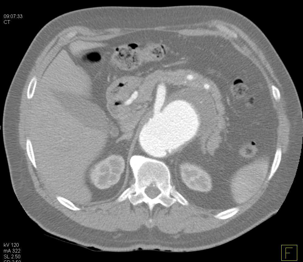 Expanding Abdominal Aortic Aneurysm - CTisus CT Scan