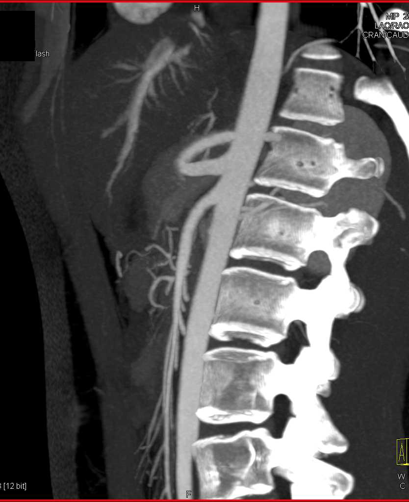 Superior Mesenteric Artery (SMA) Syndrome with Narrow SMA Angle - CTisus CT Scan