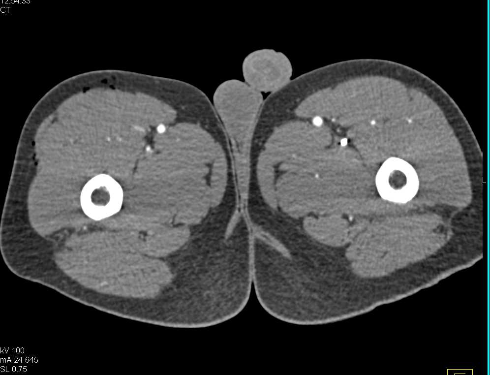 CTA Runoff with Near Superficial Femoral Artery (SFA) Occlusion on the Right - CTisus CT Scan