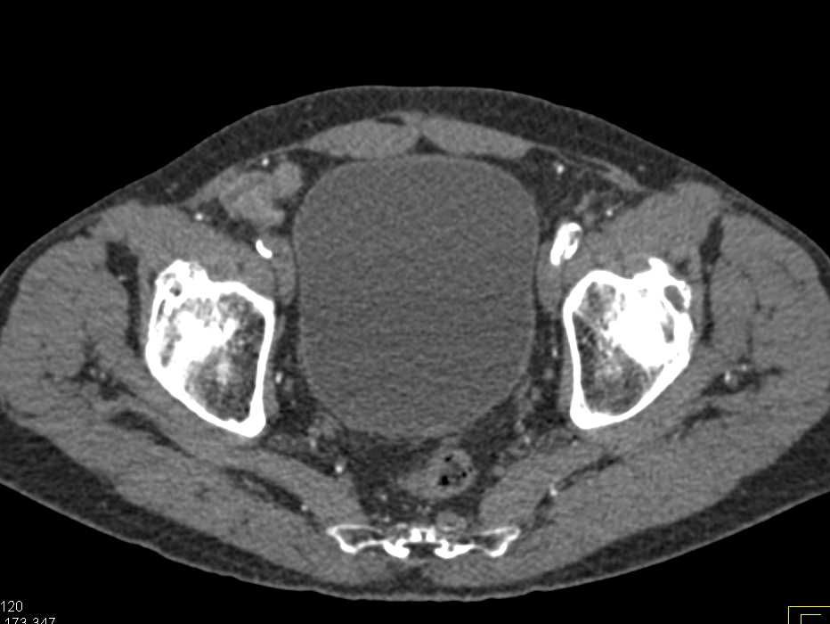 Aortic Grafts with Fem-Fem Bypass - CTisus CT Scan